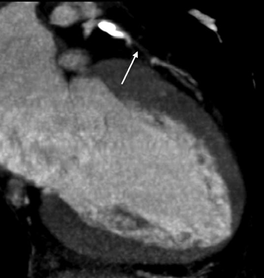 show occlusion of left anterior descending coronary artery after small first