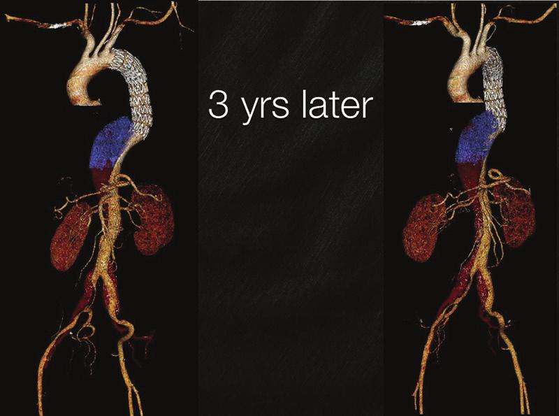 WHAT WOULD YOU DO? Residual Dissection and False Lumen Aneurysm After MODERATOR: MARK FARBER, MD PANEL: YAZAN DUWAYRI, MD; MATTHEW J. EAGLETON, MD; WILLIAM D.