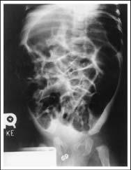 Complications of Hirschsprung Disease Acute intestinal obstruction (neonate) 95% failure to pass meconium Hirschsprung-associated enterocolitis (HAEC) Explosive foul-smelling diarrhea, fever,