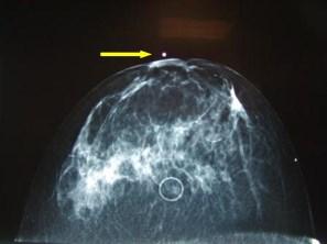 Breast Tomosynthesis.