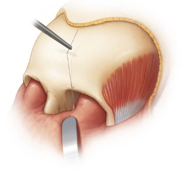 Capture Tendon continued 4 Capture tendon continued Alternate Method: Instead of a skin incision below the medial