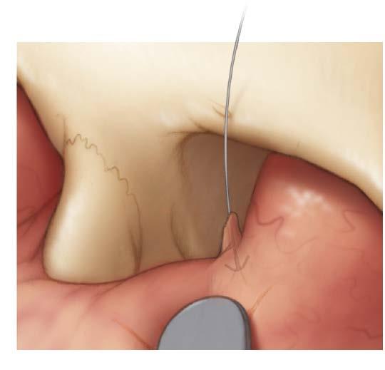 By using a caruncular incision, the barb will become engaged in the substance of the tendon after the needle and wire
