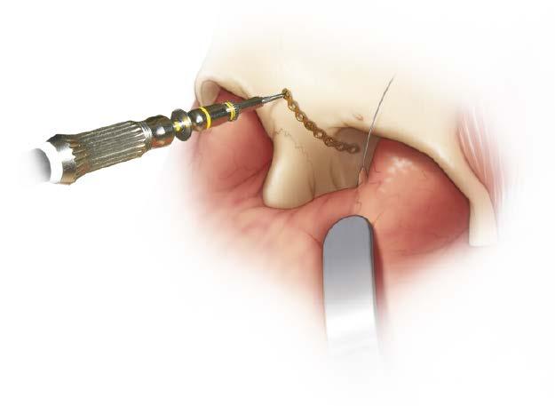 Place Tendon 5 Plan tendon position Proper tendon repair includes positioning the canthal tendon posterior and superior to the lacrimal fossa. 3 6 Place tendon To facilitate tendon placement, a 1.