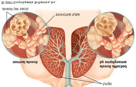 COPD - structures of the lungs are damaged