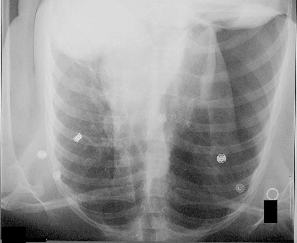 Pneumothorax Air enters the pleural cavity and it becomes mechanically