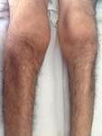 Lower Extremity Regional Variant Also known as: Flail Leg Syndrome or Marie-Patrikios Form (1918) or Pseudopolyneuritic variant or Peroneal Form or Leg Amyotrophic Diplegia (LAD) 50% with