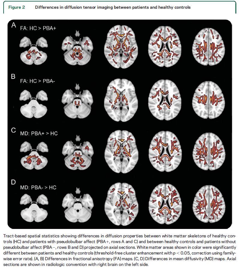 Impaired corticopontocerebellar tracts underlie pseudobulbar affect in motor neuron disorders PBA due to disruption of