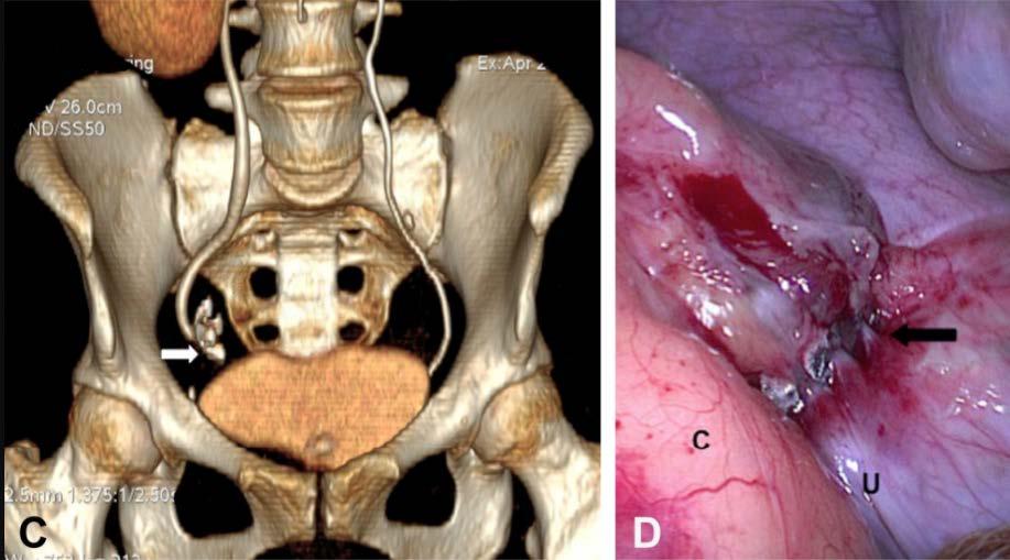 Ureteral obstruction after colonoscopic perforation closed with an over-the-scope Unknown risks Clip migration (70% in one series) Thermal injury Mechanical injury