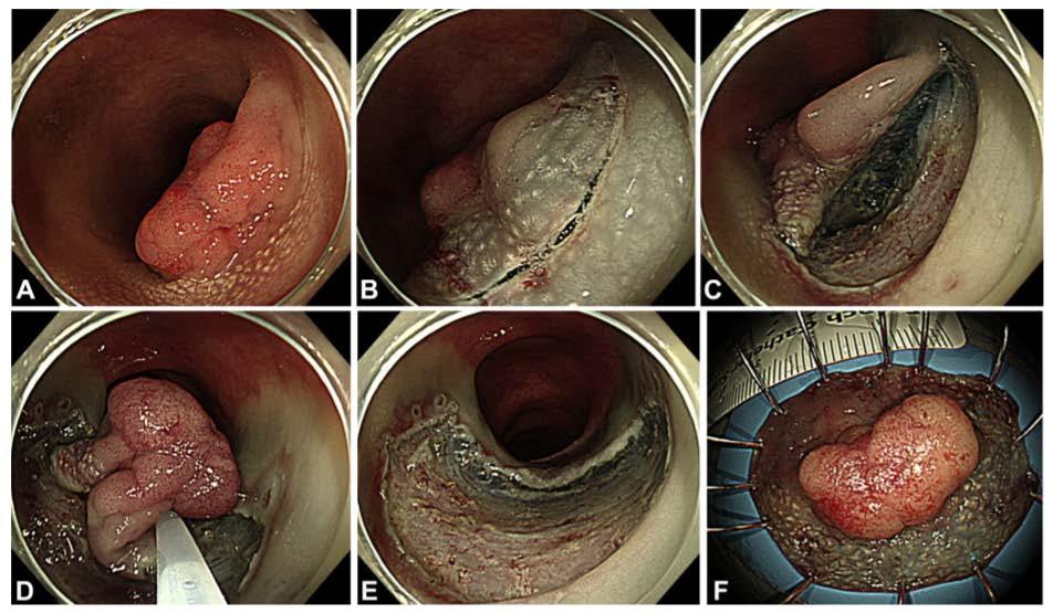 Optimized hybrid endoscopic submucosal dissection for colorectal