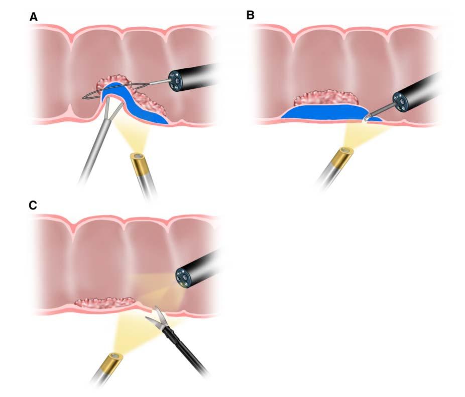 Combined endolaparoscopic surgery (CELS) Advantage Avoid bowel resection Diagnose / treat perforation Localize polyp System review of 18 studies with 532 patients Median polyp size 1.4-3.
