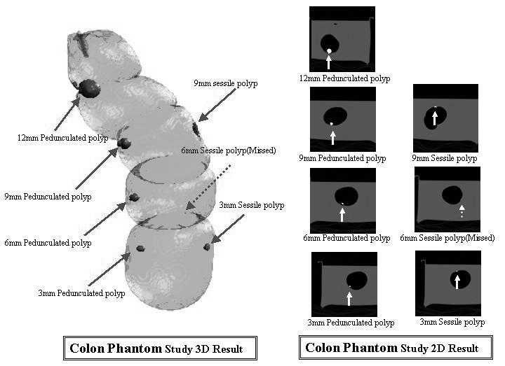 Figure 3. 3D volumetric and transaxial CT images of phantom colon polyps Figure 3. 3D volumetric and transaxial CT images of phantom colon polyps 4.