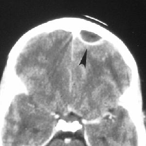Subdural abscess from frontal