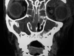Source undetermined CT scan of same
