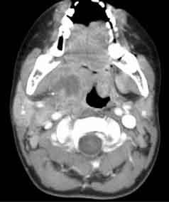 Axial CT scan of peritonsillar