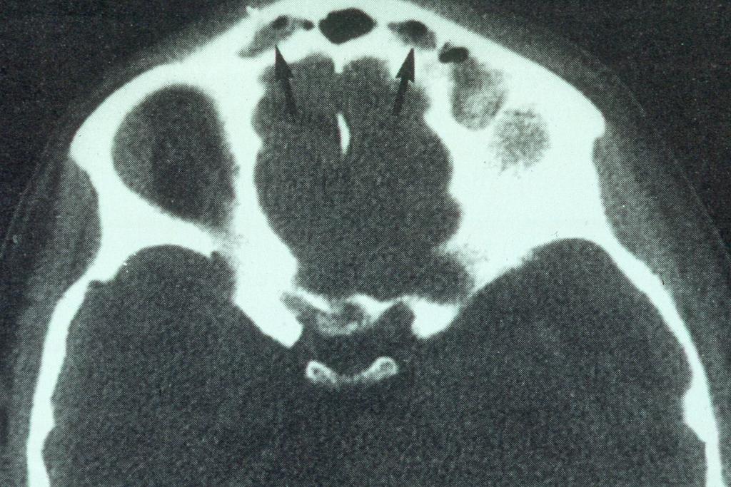CT scan showing fluid with pockets of air in frontal air cells