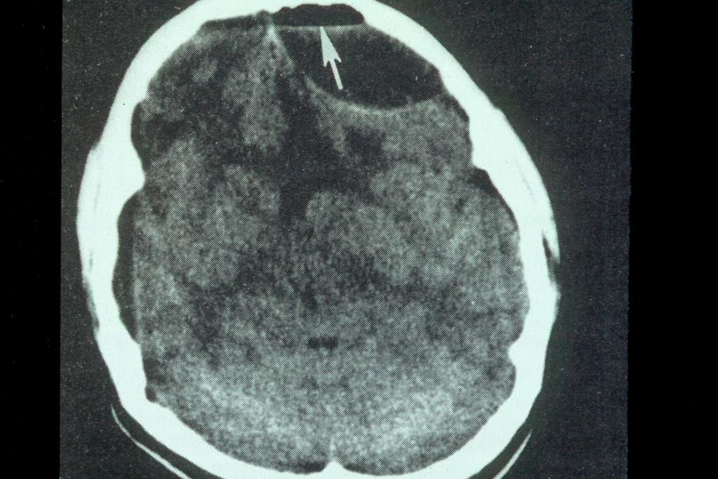 Source undetermined CT scan showing epidural abscess from