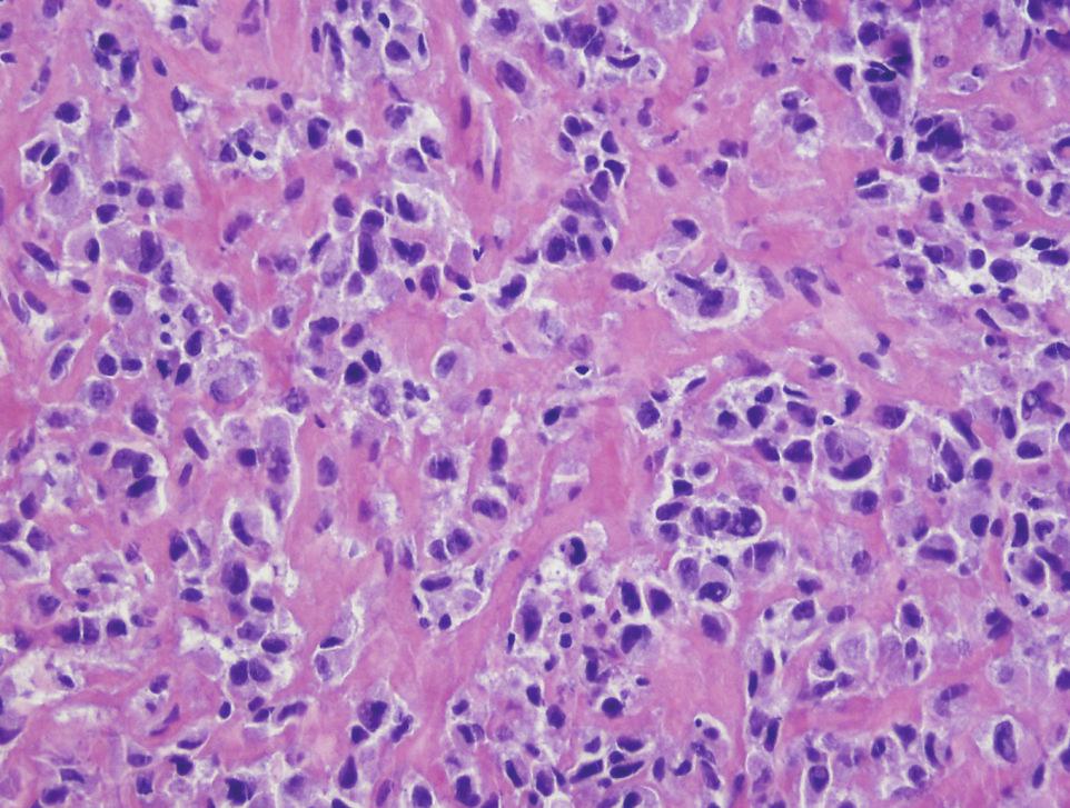 low mitotic rate (up to 4 mitoses per high power field) (Figure 5). By immunohistochemistry, the tumor stained for smooth muscle actin (SMA) and p63, with focal S-100 protein staining.