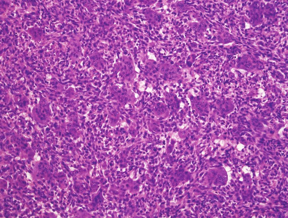The morphology and IHC staining results were consistent with transformation to osteosarcoma.