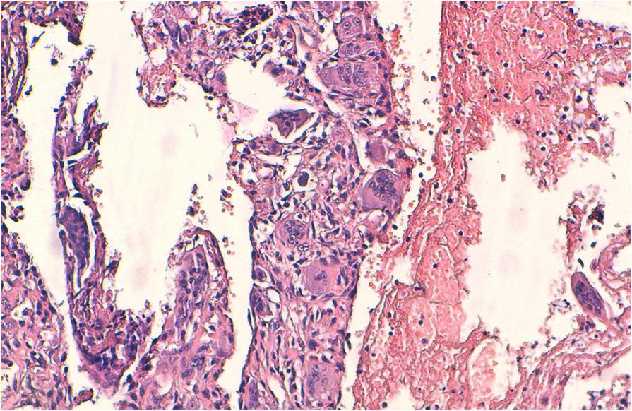 cells, many of which contain a large number of nuclei. Characteristically, the nuclei of both stromal and giant cells are very similar. (hematoxylin-eosin stain, original magnification 200).