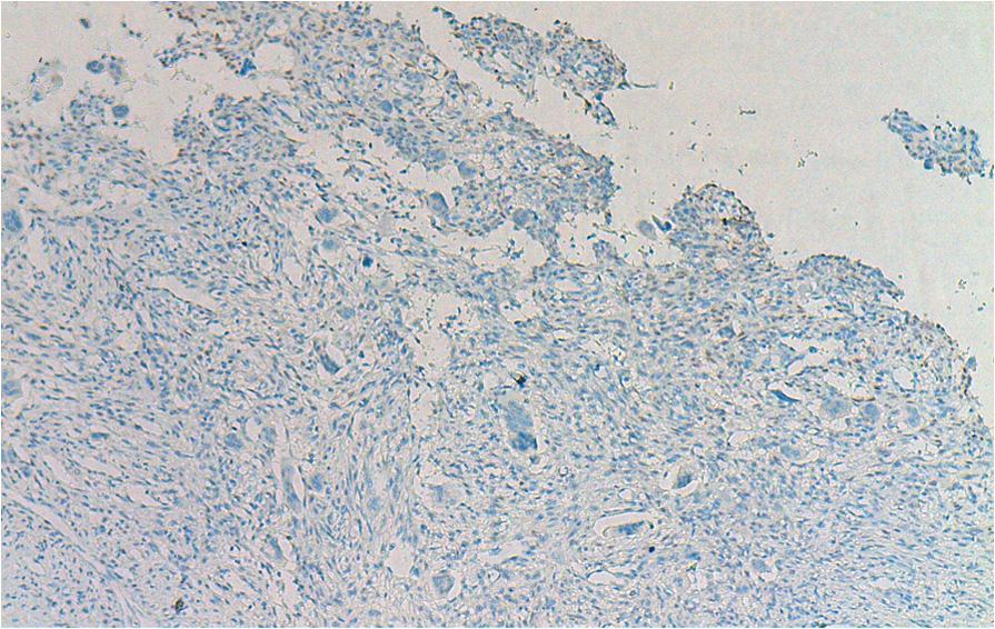 Hammas et al. Diagnostic Pathology 2012, 7:130 Figure 4 Immunohistochemical findings of GCTOB: strong nuclear staining with P63 in mononuclear cells (original magnification 100).