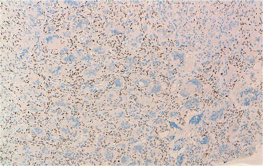 No P63 immunoreactivity was detected in any of the cases of CGCG (Figure 6), LCH, and FD. Strong staining was seen in 40% of GCTOB (2 cases) and in one case of osteoblastomas (33.