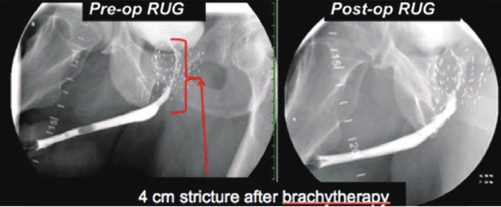 Translational Andrology and Urology, Vol 4, 1 February 2015 61 Figure 1 Pre-operative and post-operative images of a patent with a 4 cm stricture 2 years after brachytherapy and EBRT.