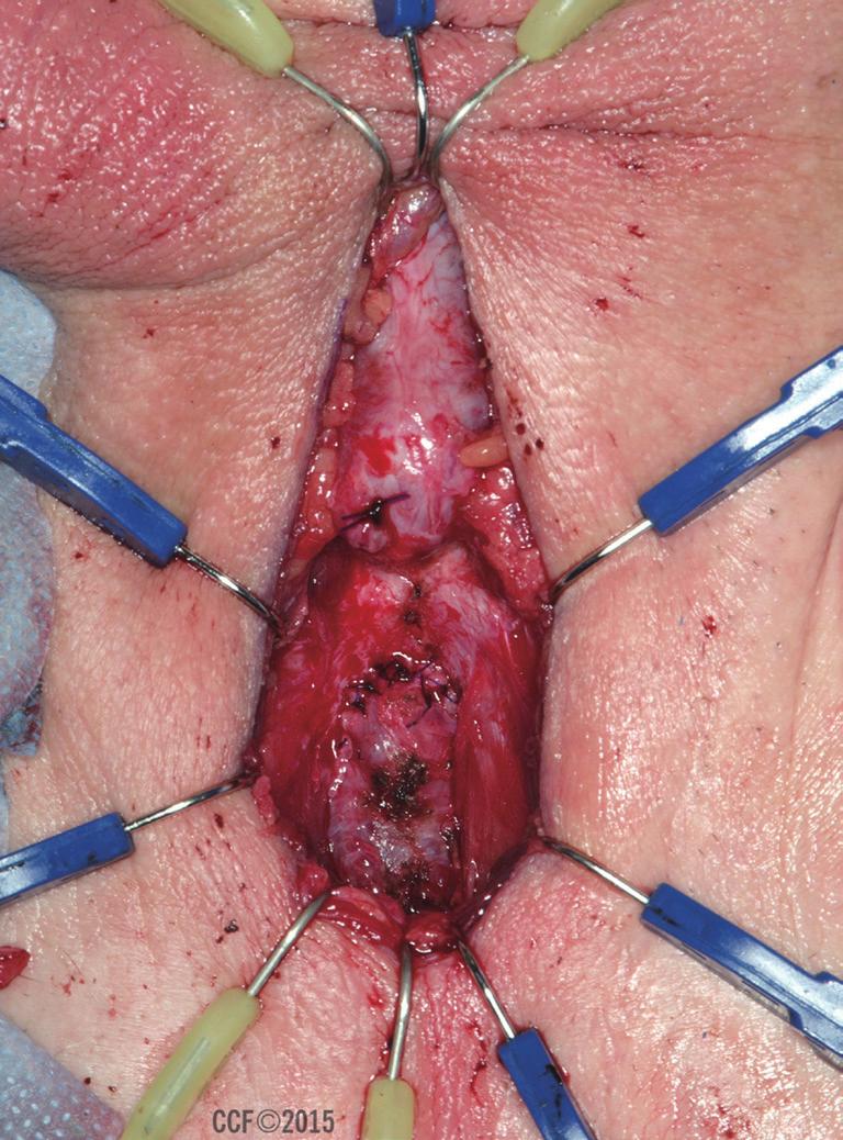 Translational Andrology and Urology, Vol 4, 1 February 2015 63 with a devastated urethra who are unwilling or unable to undergo a major abdominal operation.