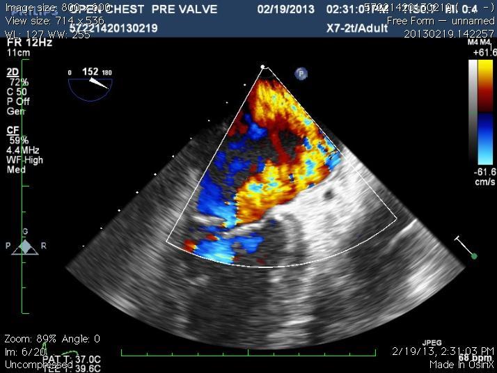PATIENT NUMBER 1 57 y.o. man from Myxomatous mitral valvular disease Echocardiographic findings MR grade 4+ Vena Contracta 8.0 mm LA size 6.46 cm Regurgitation fraction 35.