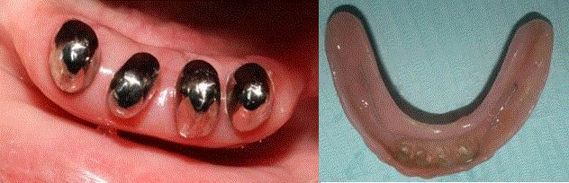 Figure 6 Occlusal view, metal copings cemented (left). The adjusted interim overdenture (right).