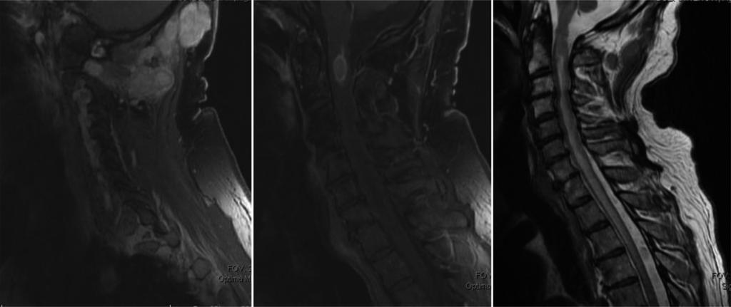Journal of Spine Surgery, Vol 2, No 1 March 2016 77 A B C Figure 1 Sagittal MRI of cervical spine.
