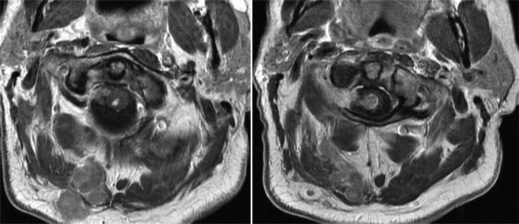 78 Asad et al. Rare presentation of Neurotropic cutaneous melanoma A B Figure 2 Axial MRI of cervical spine.