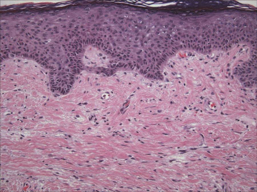 Desmoplastic Melanoma 73 Fig. 1. Histological features of desmoplastic melanoma (photograph courtesy of Dr.