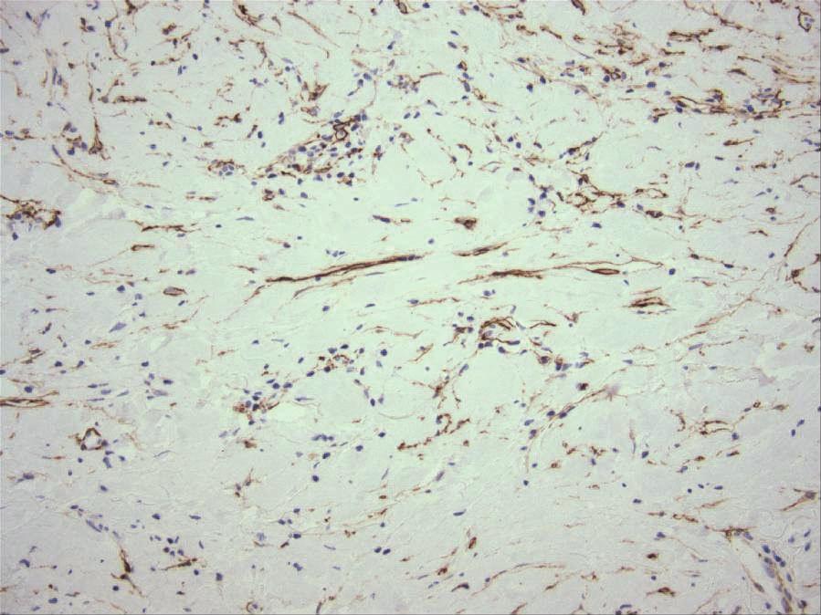 74 Advances in Malignant Melanoma Clinical and Research Perspectives Fig. 2. S100 marker staining for desmoplastic melanoma (photograph courtesy of Dr. Maxwell Fung) 5.