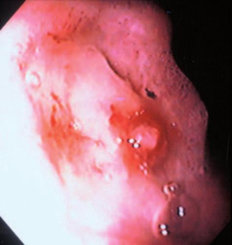 158 KAY AND WYLLIE FIG. 1. Endoscopic view of a visible vessel in a duodenal ulcer in a pediatric patient.