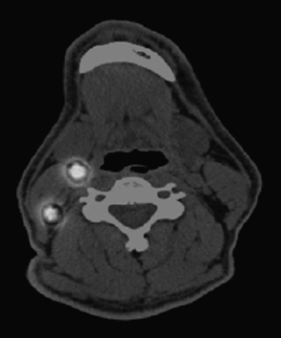 deeper within the neck adjacent to vital structures. In contrast, note clear localization of two sentinel lymph nodes (SLNs) in the axial SPECT/CT (C).