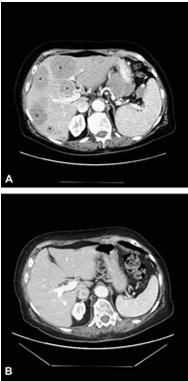 CT scan of the abdomen of a pt with stage IV melanoma with multiple liver metastases Same pt after 8 months of ipilimunab Overall Survival: Ipilimumab Adjuvant Therapy