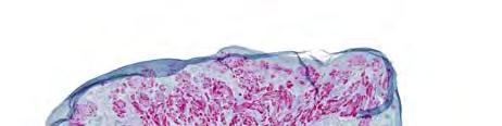 cells) 3 fold more likely to be melanoma loss of