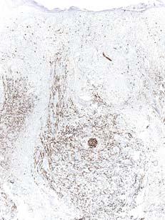 S100-protein S100-protein S100-protein Diagnosis Squamous cell carcinoma in situ over desmoplastic melanoma Definition