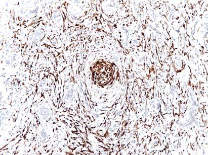 desmoplastic melanoma ordinary melanoma with focal desmoplasia neurotropic melanoma prominent perineural growth and