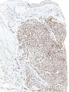 in 1971 a) spindle cell proliferation, composed of single cells or at most small aggregates of 2-3 cells, separated by