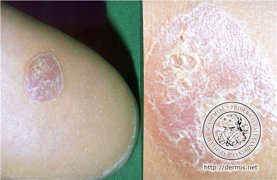 0 mm for other melanomas >90% are Clark s level IV or V at presentation Delay of diagnosis clinical recognition