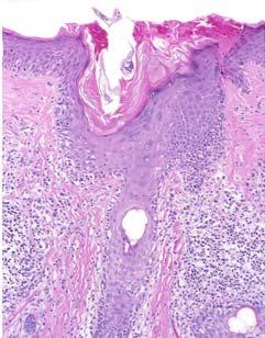 dermatofibroma bland histology, resembling fibrohistiocytic proliferation superficial/ partial biopsies Histology
