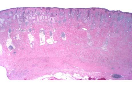 myxoid stroma invasion of perineurium invasion of endoneurium Architecture for pure DM pink tumor ill