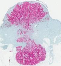 Pathol 2015 Spitzoid tumors