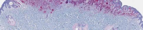 melanocytic tumors (BAPimts ) Uveal melanoma Cutaneous melanoma Leptomeningeal