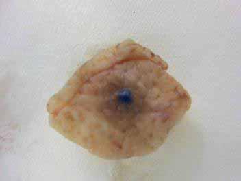 Excision nevus with