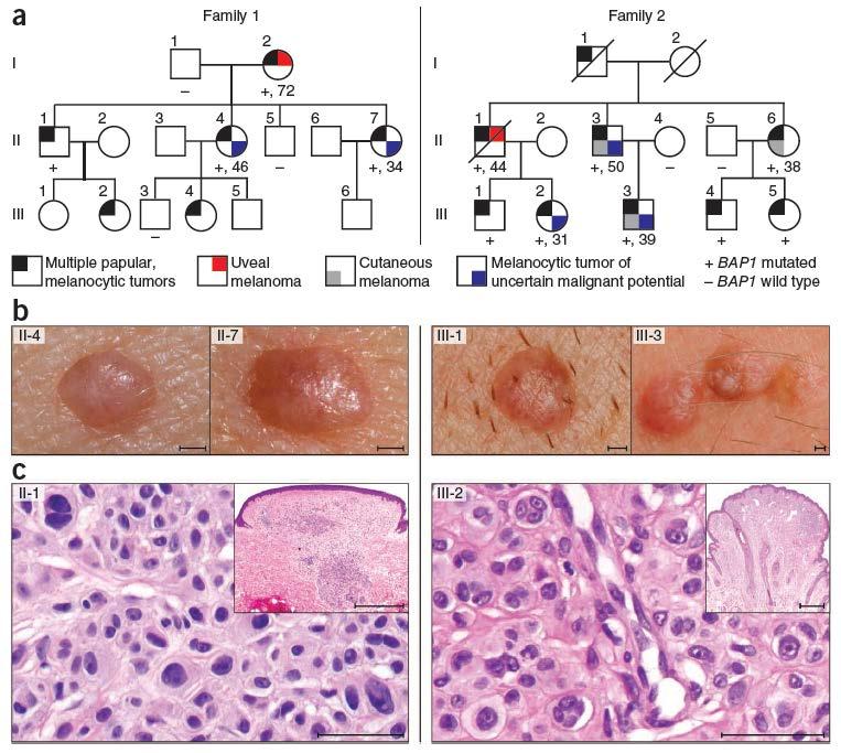 Germline BAP1 loss confers risk to develop melanocytic tumors with distinct morphology Two