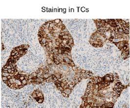 PD L1 expression on TCs and ICs IC Score PD L1 IC staining TC Score PD L1 TC staining IC3 IC 1% TC3 TC 5% IC2 IC 5% and < 1% TC2 TC 5%