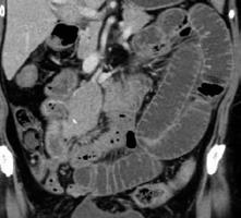 Figure 11. A preoperative scan showing partial bowel obstruction and a large mesenteric mass. challenged are not great candidates for major surgery.