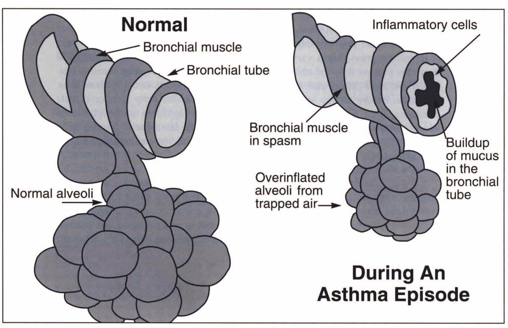 7 The Asthma Episode The main symptoms of acute asthma episodes are shortness of breath, wheezing, tightness in the chest, and/or recurrent cough.
